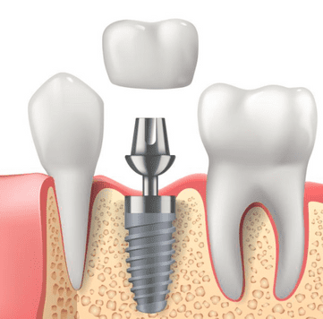 Clínica dental Idami dibujo de implante 